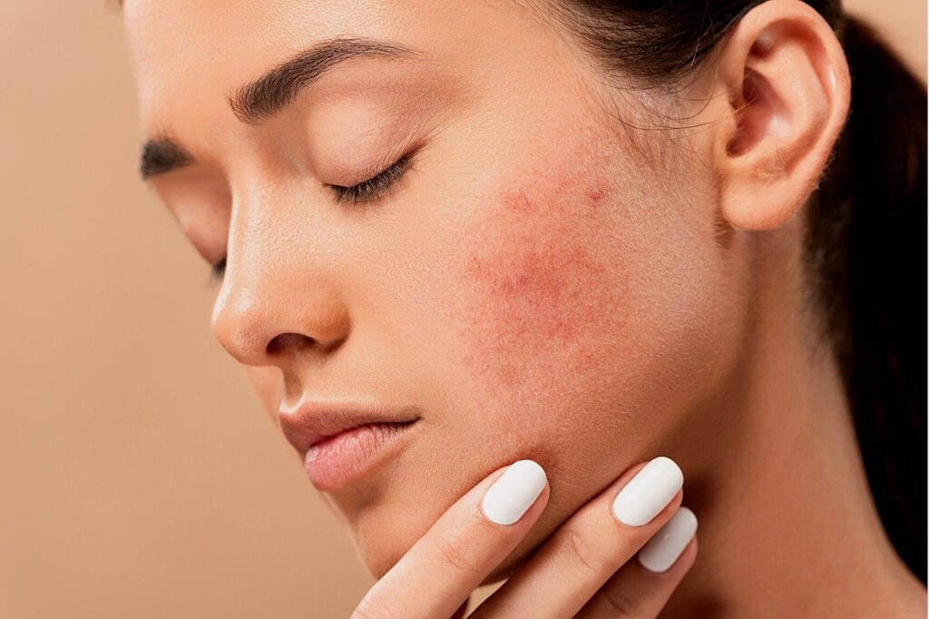 5 Tips on How to Prevent Pimples on Face Forever